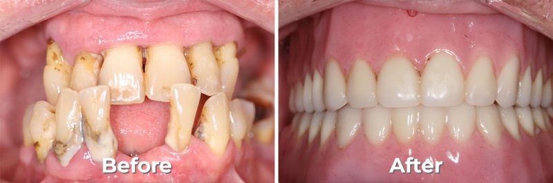 Dentures & Partials in West Grove