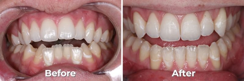 Invisalign in West Grove