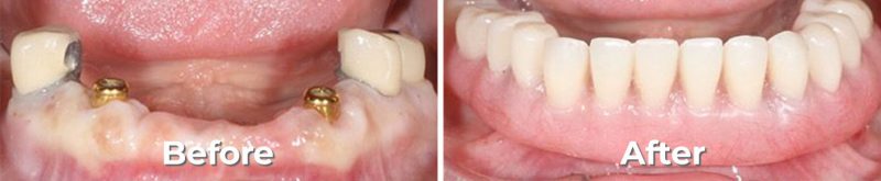 Implants Dentist in West Grove