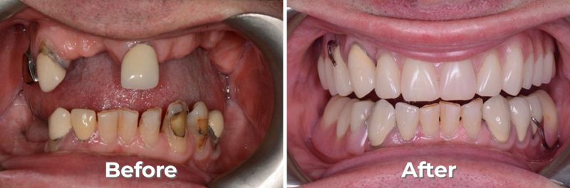 Dentures & Partials in West Grove