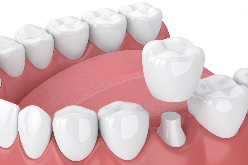 Dental Crowns in West Grove
