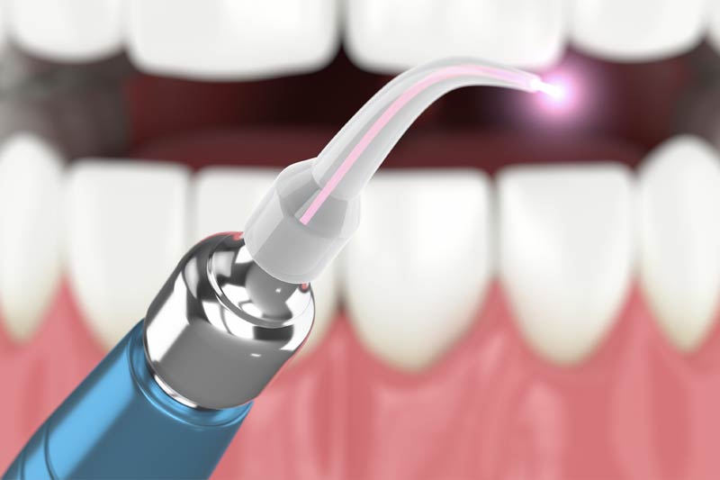 Laser Dentistry in West Grove