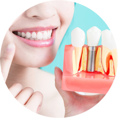 Dental Implants photo