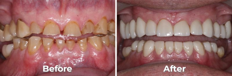 Full Mouth Reconstruction