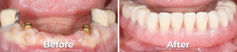 Implant Denture