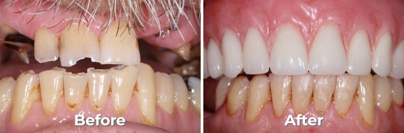 Implant Overdenture