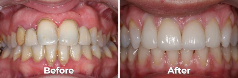 Metal Free Crowns