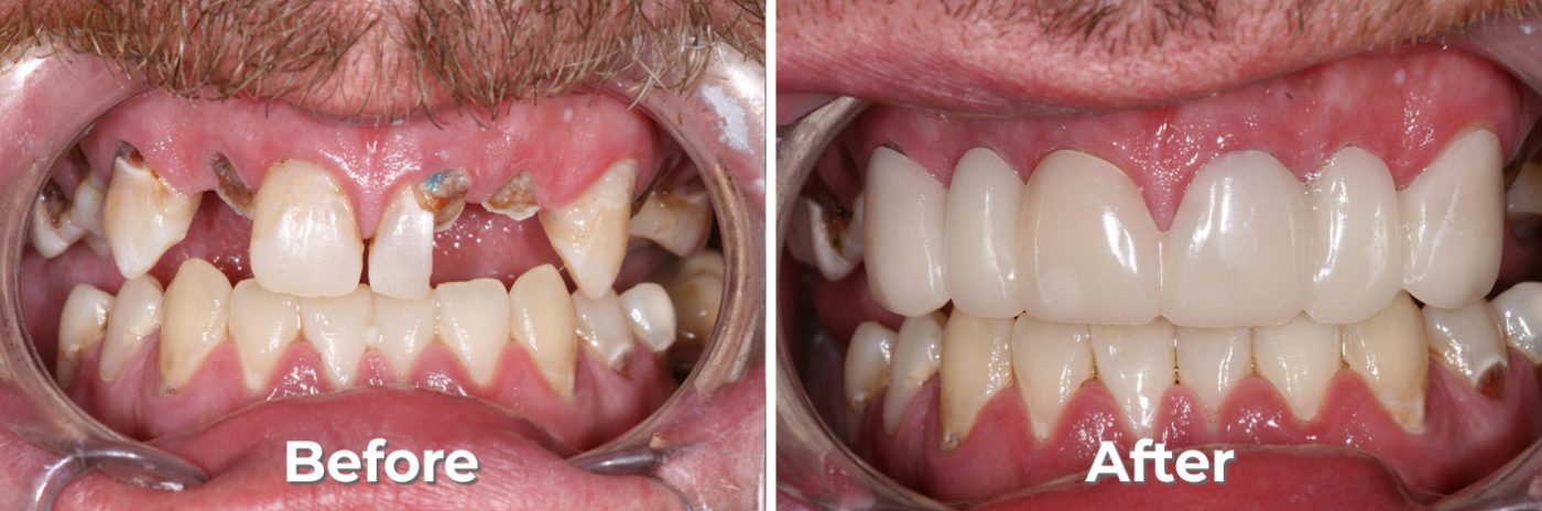 Snap on Smile – Premier Dental