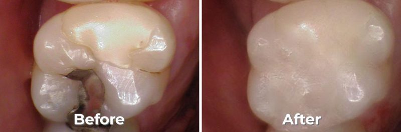 Tooth Colored Fillings