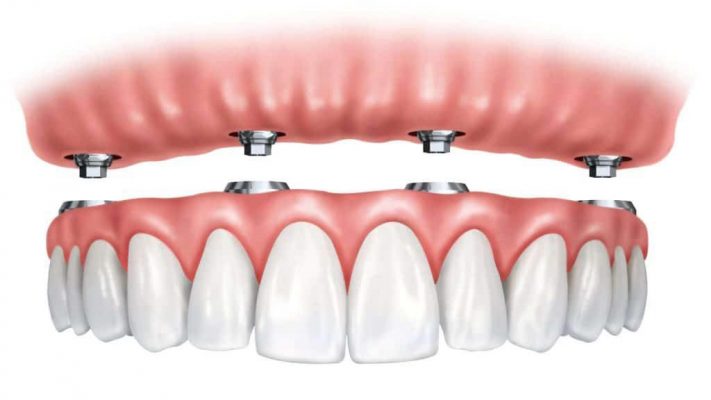 implant Overdenture Cartoon