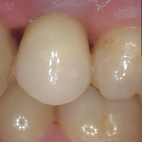 Implant Single Crown